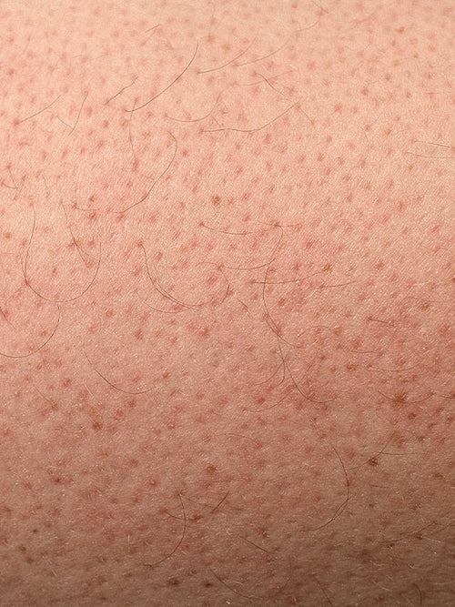 Reibende Eisenhaut - Ursachen, Symptome und Tipps