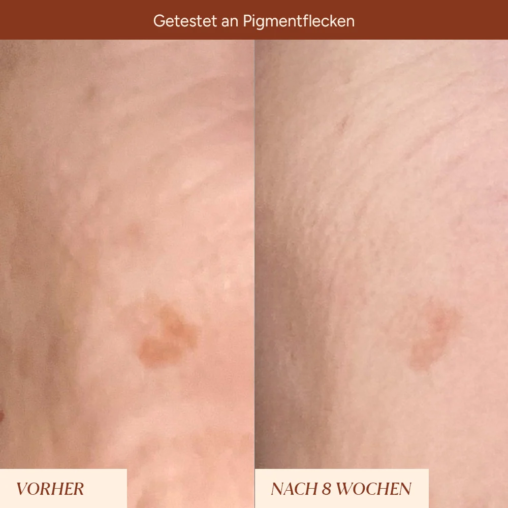 Pigmentflecken & Pickelmale Roll-On