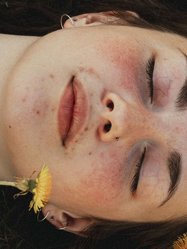 Rosacea: Ursachen, Pflege und Tipps für den Alltag