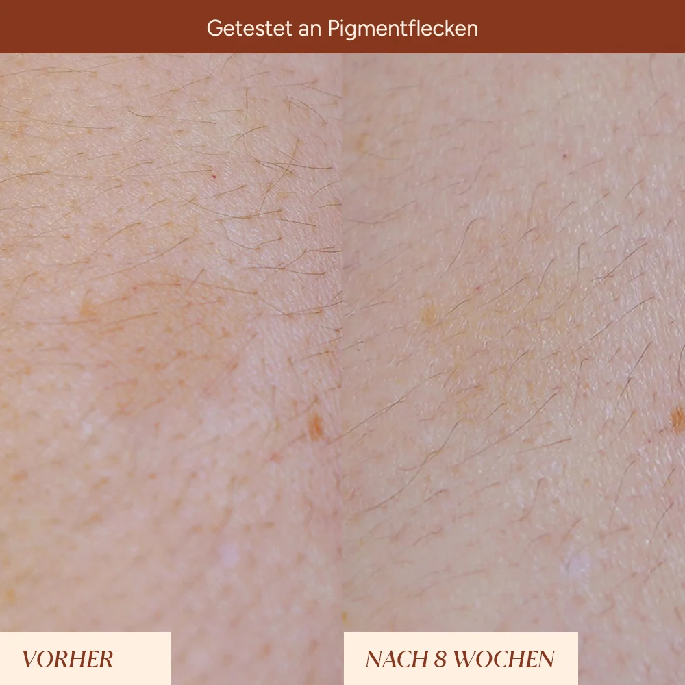 Pigmentflecken & Pickelmale Roll-On