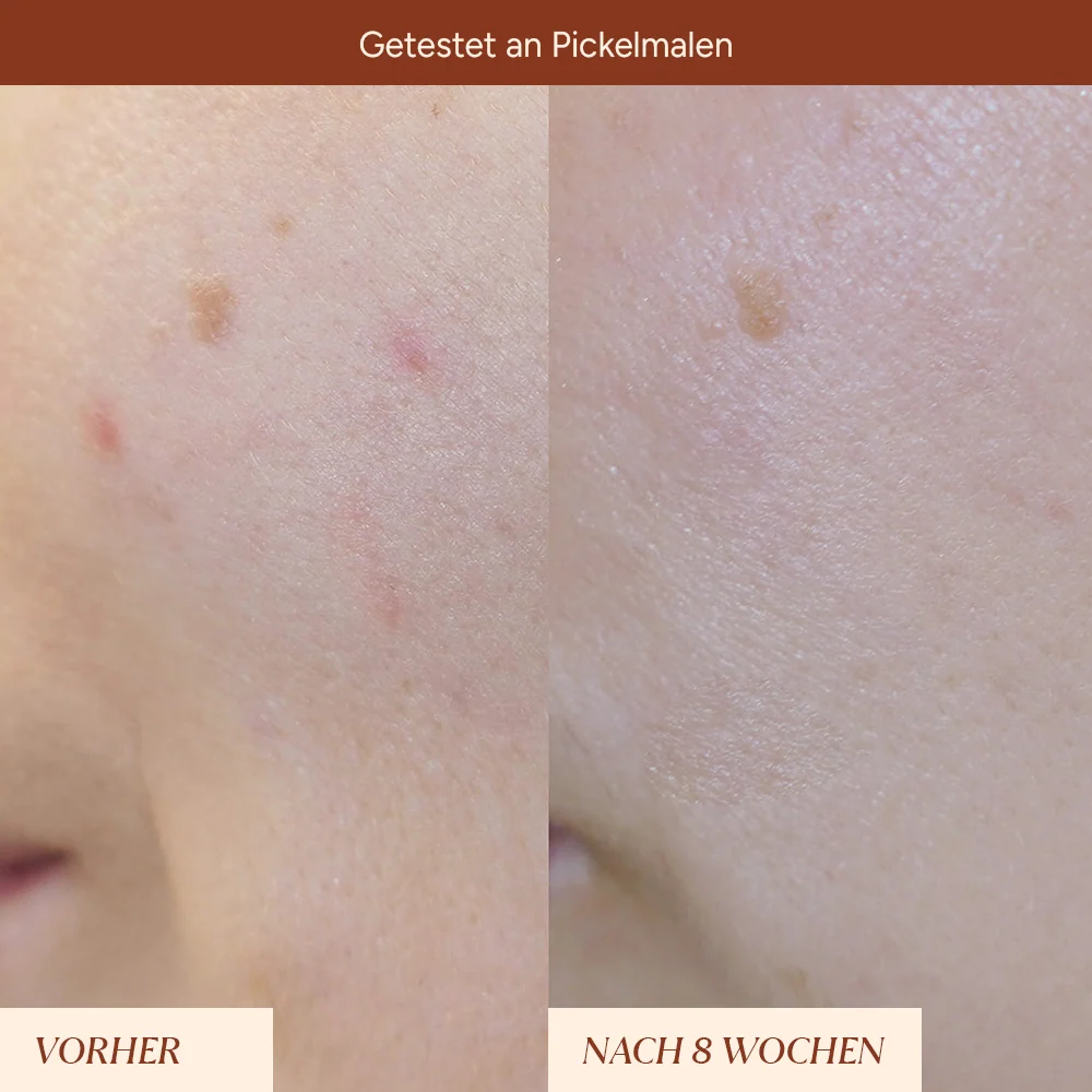 Pigmentflecken & Pickelmale Roll-On