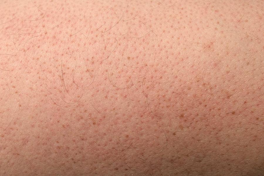 Reibende Eisenhaut - Ursachen, Symptome und Tipps